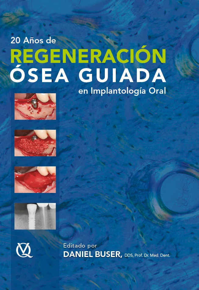 20 Años de Regeneración Ósea Guiada en Implantología Oral