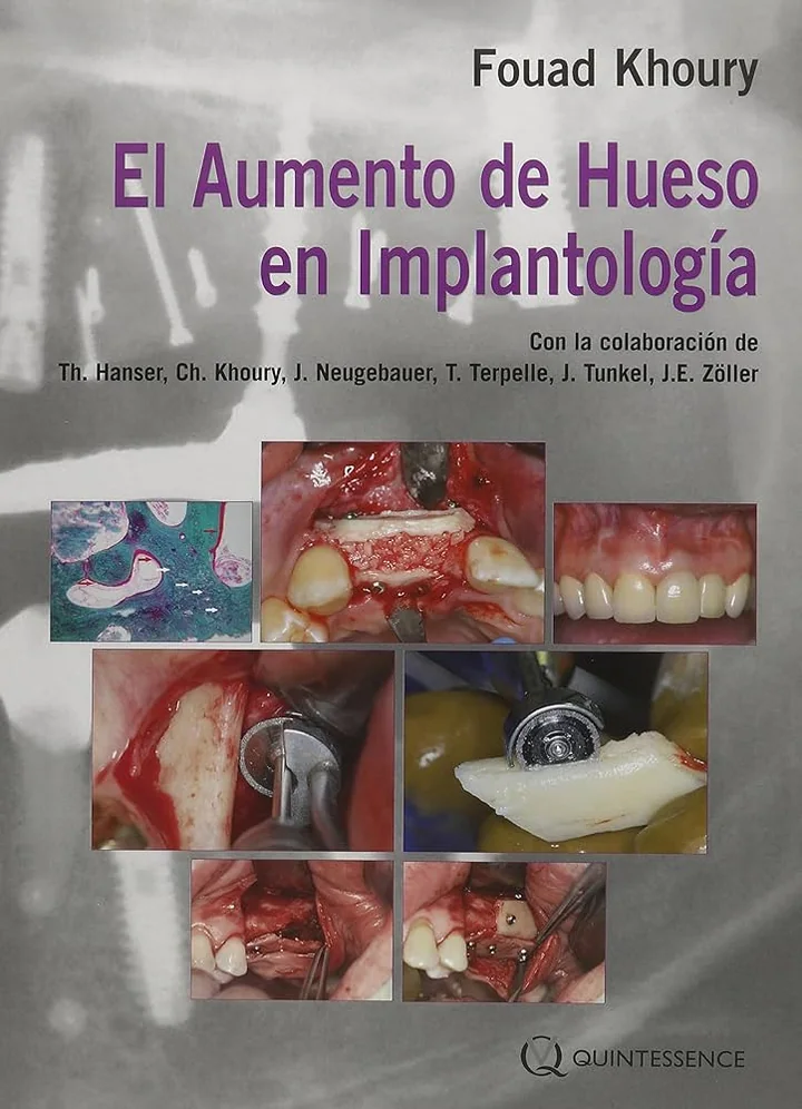El Aumento de Hueso en Implantología
