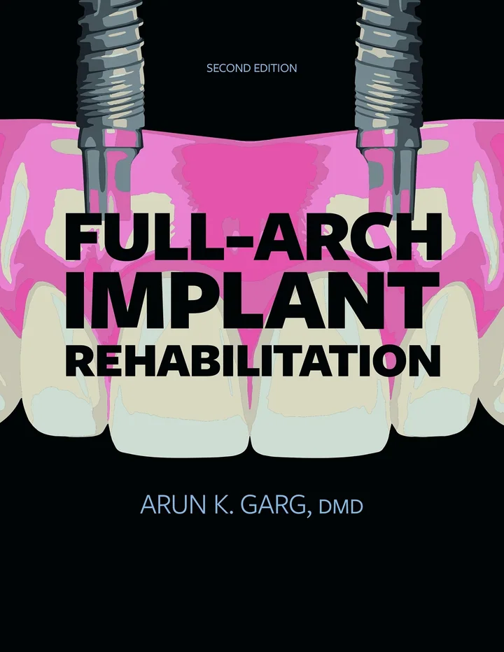 Full-Arch Implant Rehabilitation