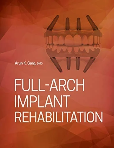 Full-arch Implant Rehabilitation