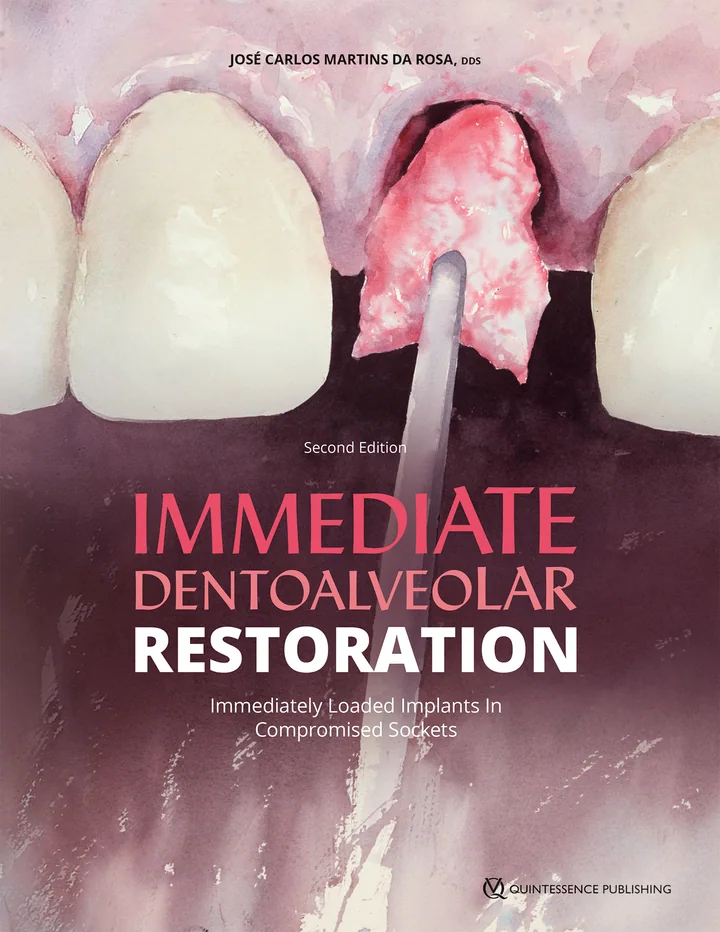 Immediate Dentoalveolar Restoration: Immediately Loaded Implants in Compromised Sockets