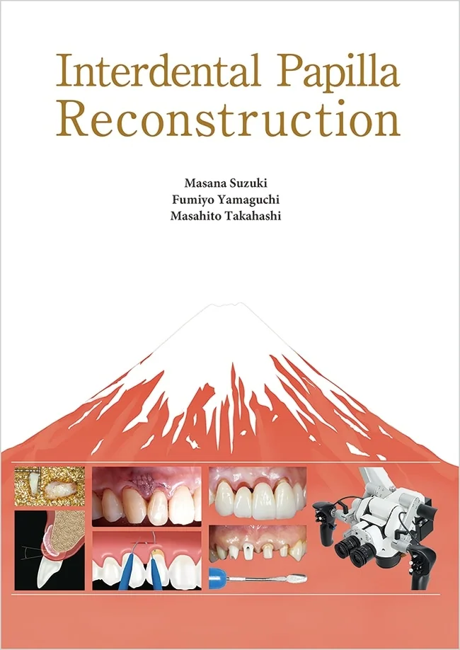 Interdental Papilla Reconstruction