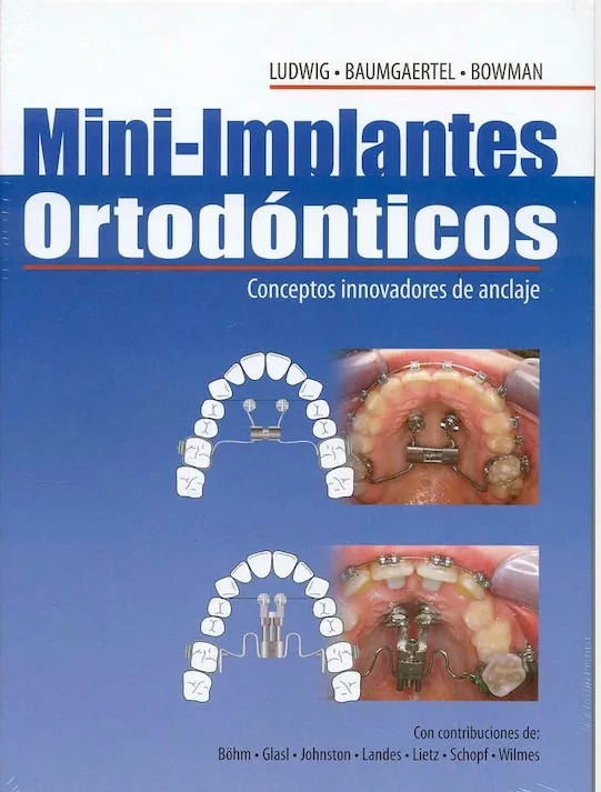 Mini-implantes Ortodónticos