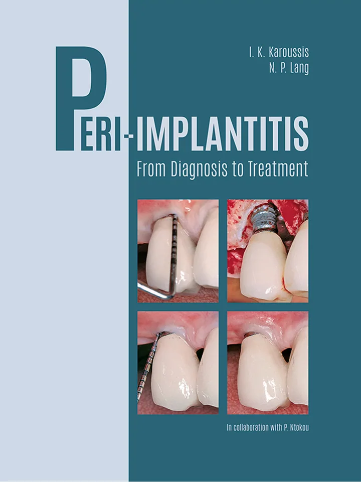 Peri-Implantitis: From Diagnosis to Treatment