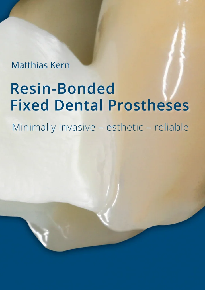 RBFDPs - Resin-Bonded Fixed Dental Prostheses: Minimally Invasive - Esthetic - Reliable