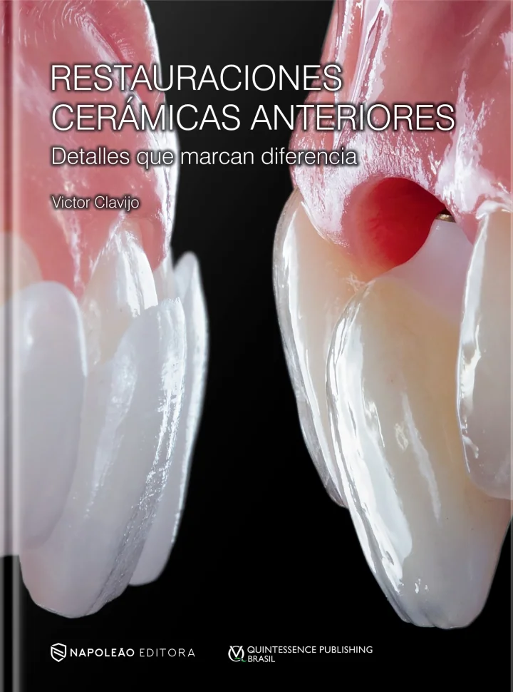 Restauraciones Cerámicas Anteriores – Detalles Que Marcan Diferencia