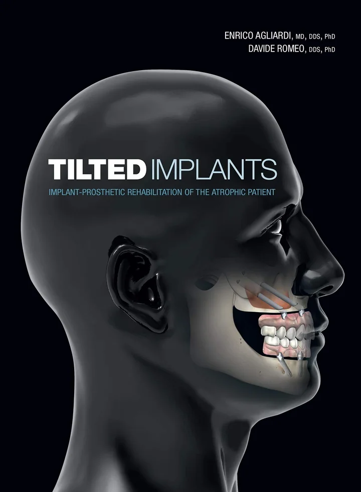 Tilted Implants: Implant-Prosthetic Rehabilitation of the Atrophic Patient