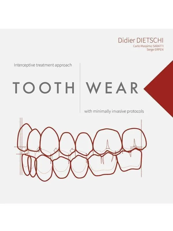 Tooth Wear: Interceptive Treatment Approach With Minimally Invasive Protocols