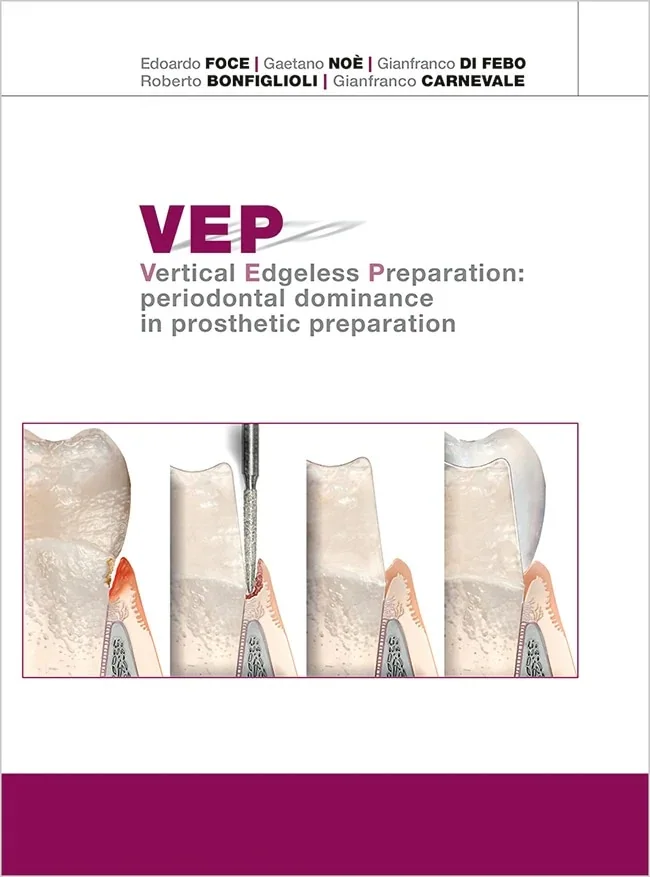 VEP. Vertical Edgeless Preparation: Periodontal Dominance in Prosthetic Preparation